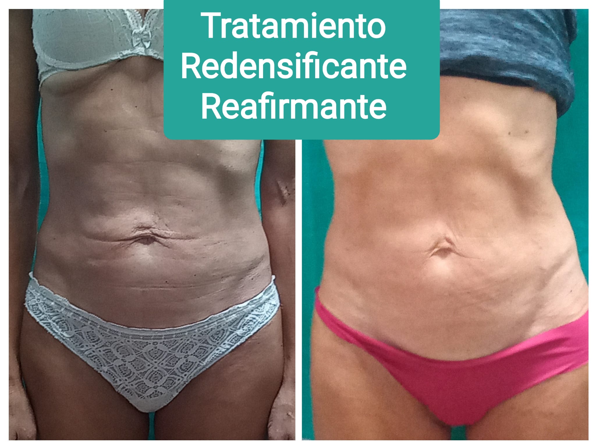 Tratamiento redensificante y reafirmante