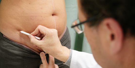 Abdominoplastia 
